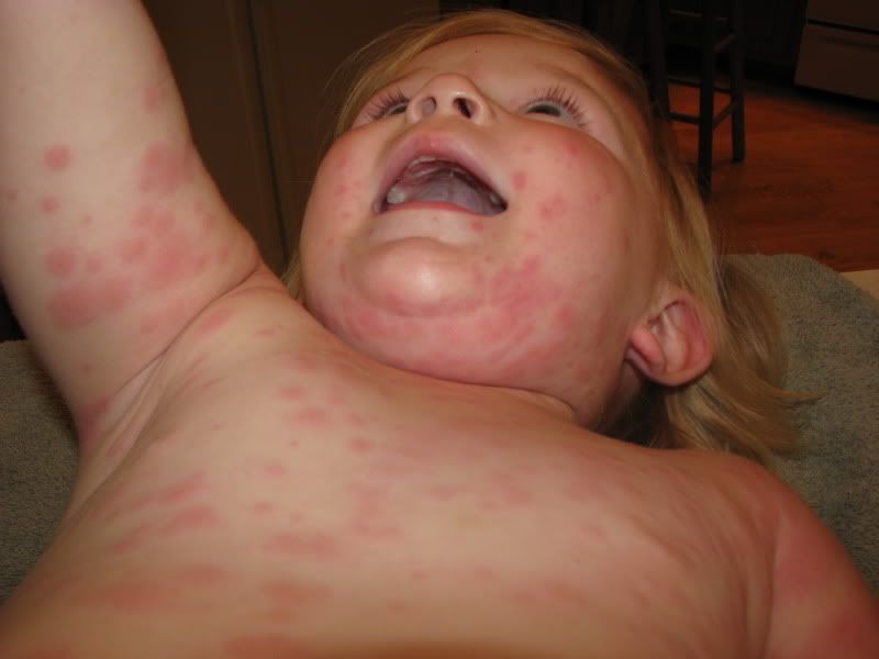 rashes on kids