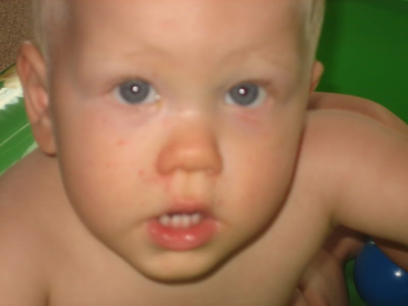 Here#39;s a pic DS#39;s rash a few heat rash on face pictures. Here#39;s a pic DS#39;s rash a few