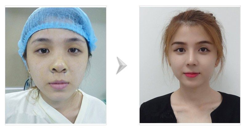Thu gọn cánh mũi